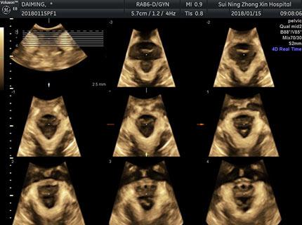 孕中期系统超声检查是四维还是三维