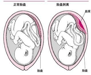 胎儿头和脚在子宫里的哪个位置