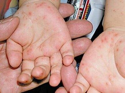 春季幼儿常见的疾病有哪些?