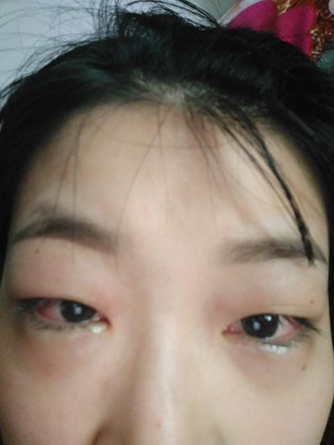 两岁宝宝结膜炎怎么办