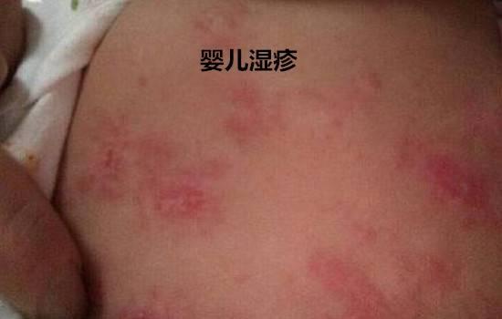 嬰兒臉上長熱疹怎麼辦嬰兒臉上老長熱疹怎麼辦