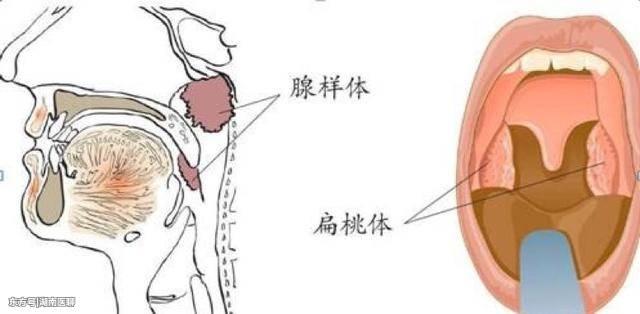 扁桃體經常發炎要切嗎扁桃體經常發炎要切除嗎