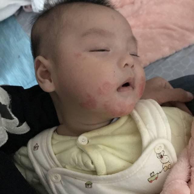 宝宝口水疹怎么治疗和护理