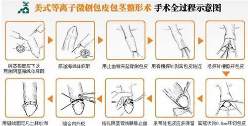 小孩包茎几岁手术好图片