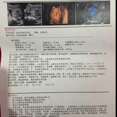 胎儿永久性右脐静脉是什么意思