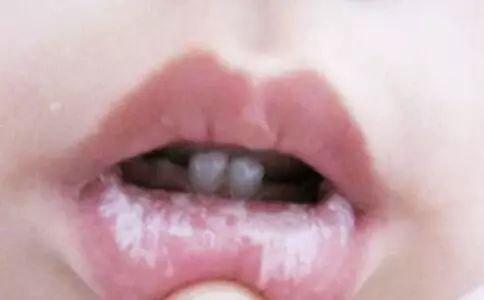 宝宝生鹅口疮了怎么办