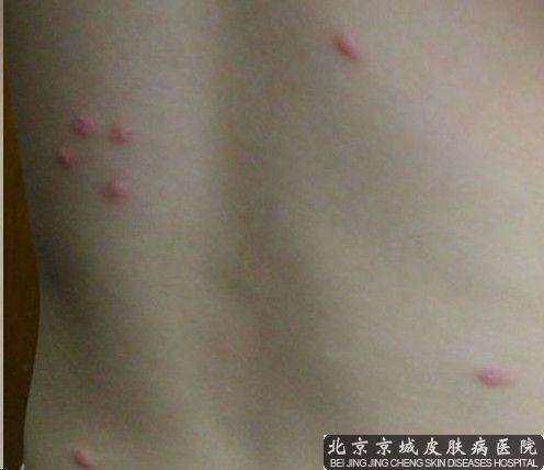 小儿荨麻疹需要治疗吗
