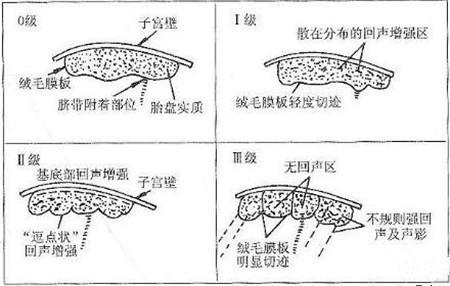 36周胎盘成熟度3多久能生