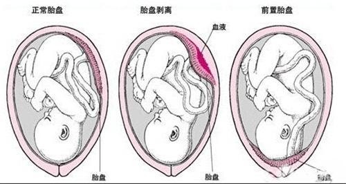 什么是前置胎盘有什么危险