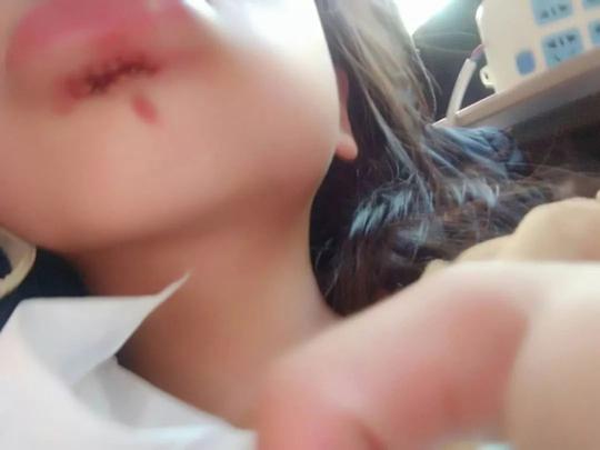 萧山10岁女孩放学路上掉井里,嘴巴缝了20多针,责任谁承担?