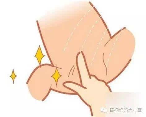 小儿外阴粘连怎么办