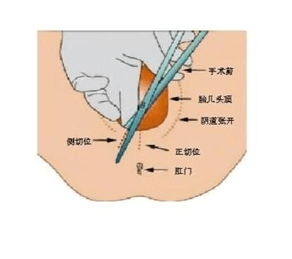 分娩期护理注意事项