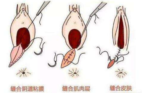 自然分娩都要侧切吗