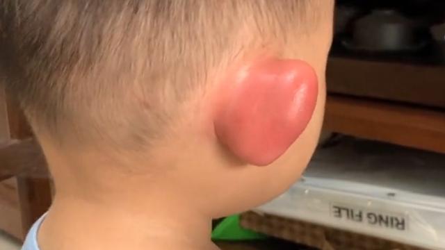 4个月小孩被蚊子咬了怎么办