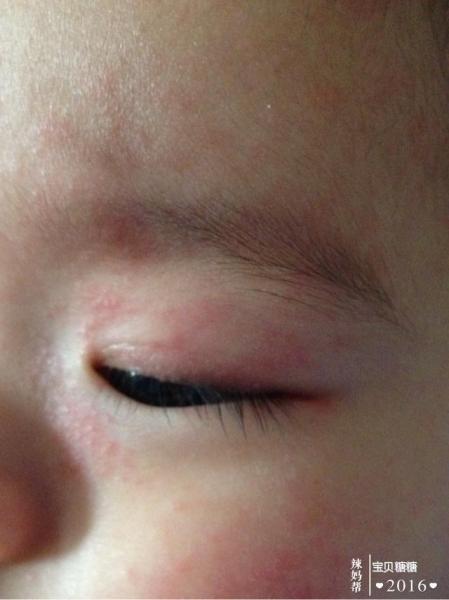 宝宝发高烧时眼睛要格外呵护