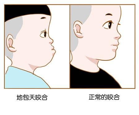 小孩子牙齿地包天是怎么形成的