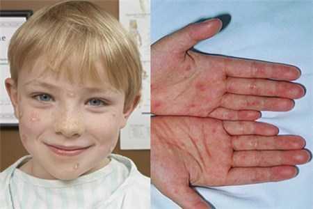 幼儿水痘的预防措施