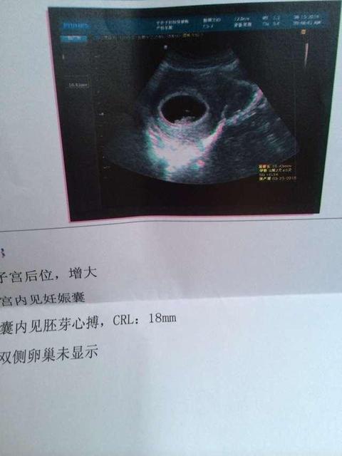 孕6周b超能看到孕囊吗