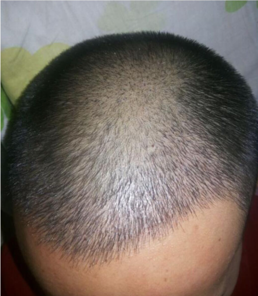 宝宝脱发怎么办