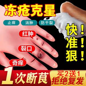 宝宝长冻疮用什么好得快