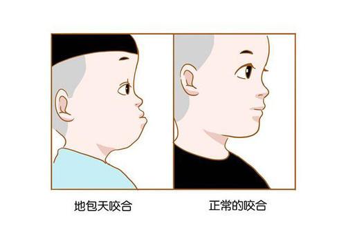 乳牙反颌最佳矫正时期是几岁
