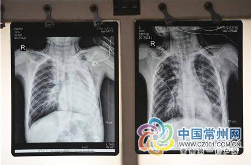 1岁半宝宝支气管肺炎