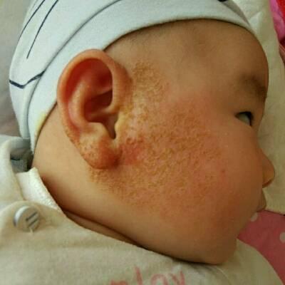 宝宝湿疹老是不好