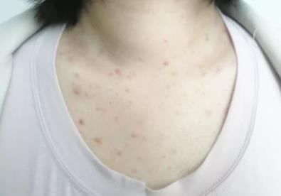 床上螨虫咬了会有什么症状