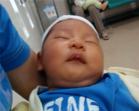 母乳性黄疸影响孩子智力吗