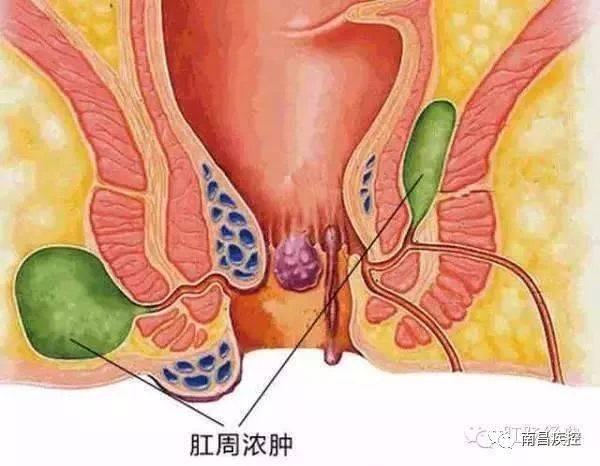 怎么样预防宝宝红屁股