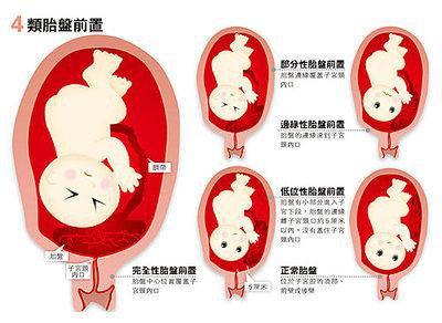 完全前置胎盘几个月最危险