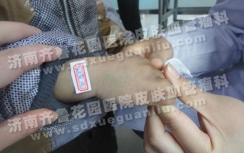 新生婴儿血管瘤严重吗