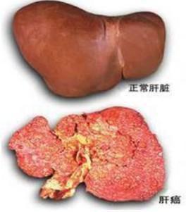 肝癌有哪些早期症状和前兆