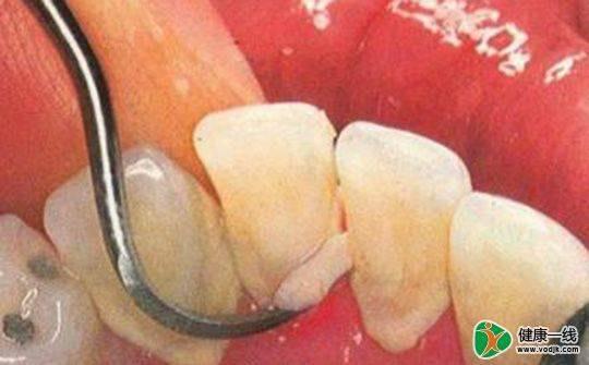 哺乳期发奶的食物有哪些