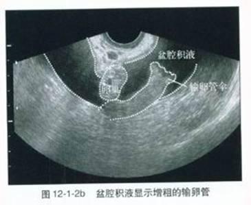 盆腔积液怎么食疗偏方