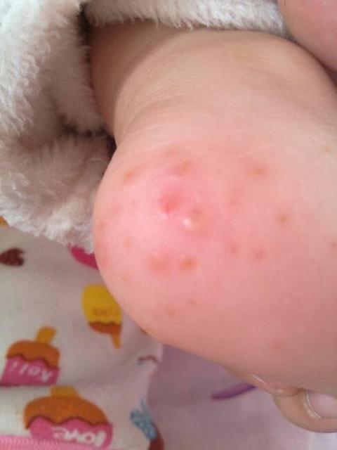 三岁宝宝有脚气怎么办