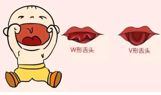宝宝舌系带短要切开吗