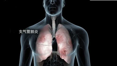 O型血相对不易感染新冠肺炎是真的吗