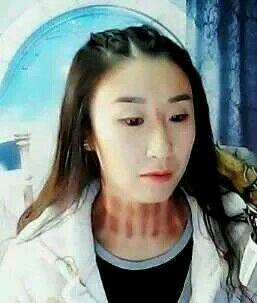 【图片】挤痧【揪痧吧】_百度贴吧185x220