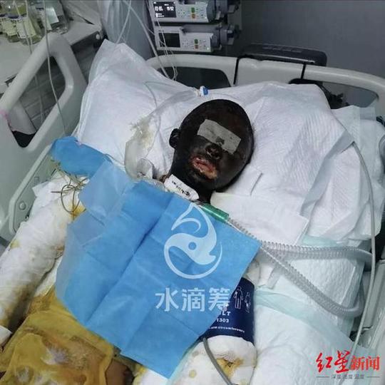 网红“拉姆”直播时遭前夫纵火烧伤一天内网友捐助100万