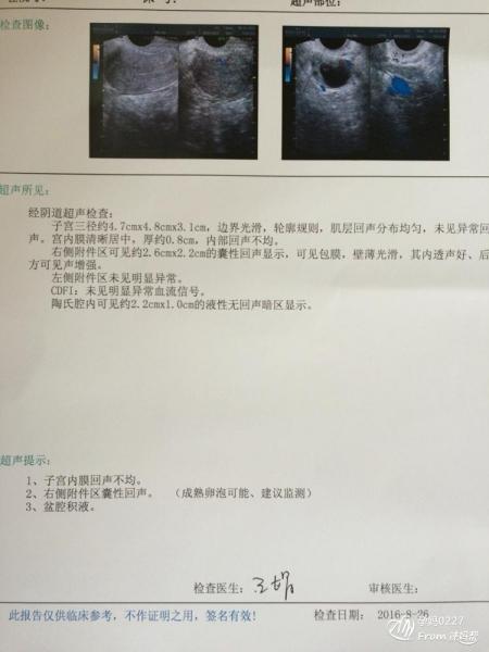 哪些备孕女性需要B超监测排卵