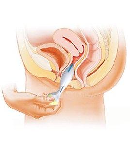 产后做盆底康复有用吗