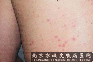 半岁宝宝皮肤过敏怎么办