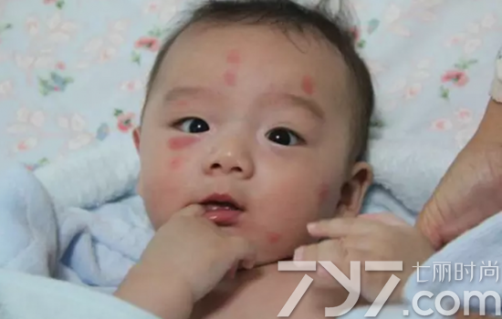 小孩总爱被蚊虫叮咬咋办