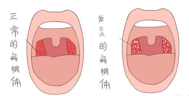宝宝扁桃体发炎引起发烧不退怎么办