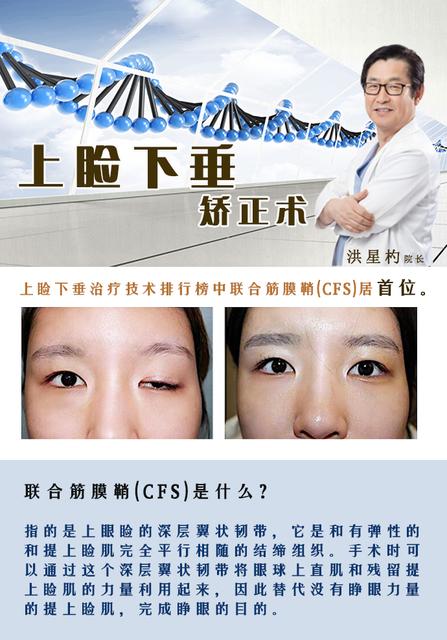 双眼皮手术会影响视力吗