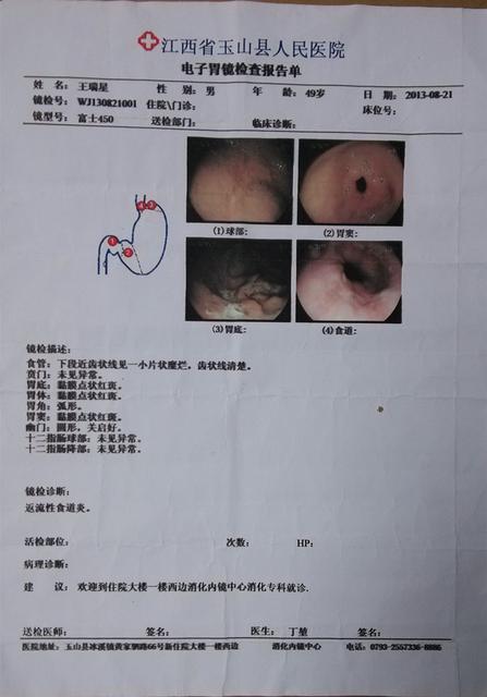 反流性食管炎有什么症状