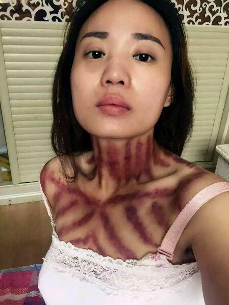 给一年级小孩揪痧视频直播