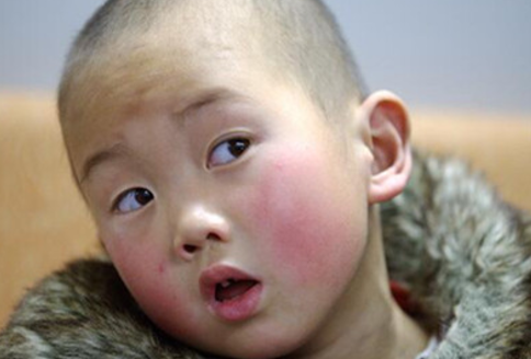 小孩子过敏了怎么办