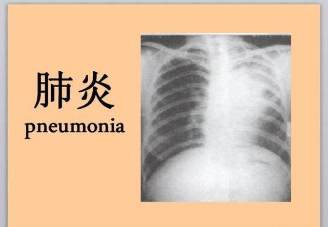 宝宝吐泡泡就是肺炎吗